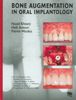 Bone Augmentation in Oral Implantology