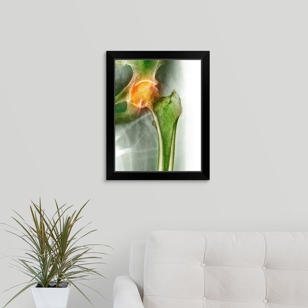 "Arthritis of the hip, X-ray" Black Framed Print