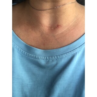 scar skinmedica recovery gel ounce barely miracle noticeable thyroidectomy didn cream should much use