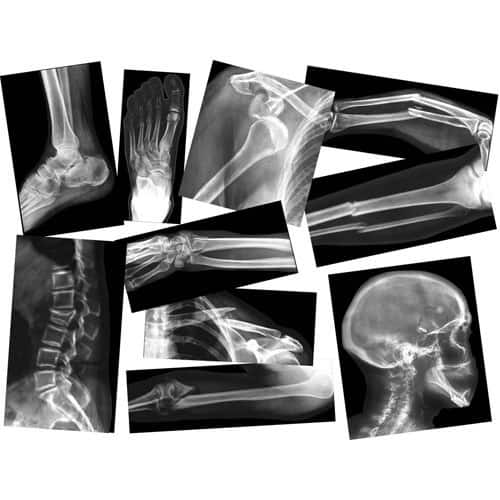 https://ak1.ostkcdn.com/images/products/is/images/direct/5726c65c8ea2dd86439714c82a292798959dfe87/Broken-Bones-X-Rays.jpg?impolicy=medium