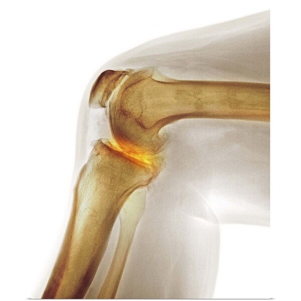 "Arthritis of the knee, X-ray" Poster Print