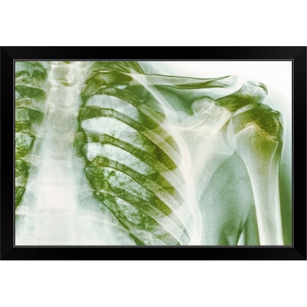 "Normal shoulder, X-ray" Black Framed Print