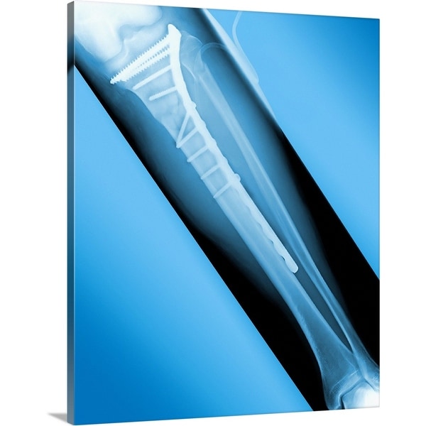 "Pinned broken leg, X-ray" Canvas Wall Art