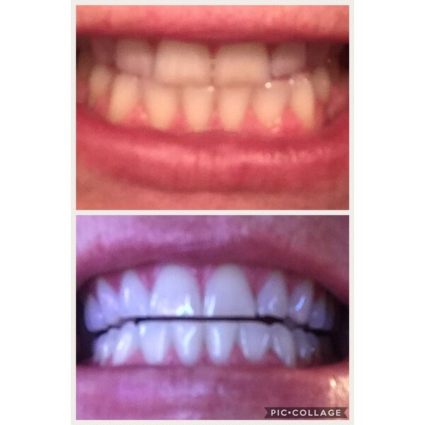 Shop Glo Science Brilliant Personal Teeth Whitening Device Overstock 8775329
